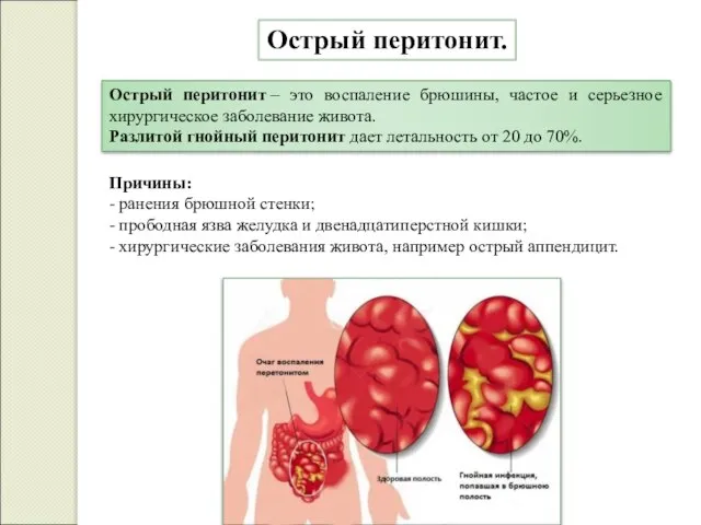 Острый перитонит. Острый перитонит – это воспаление брюшины, частое и серьезное