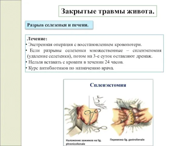 Закрытые травмы живота. Разрыв селезенки и печени. Лечение: Экстренная операция с