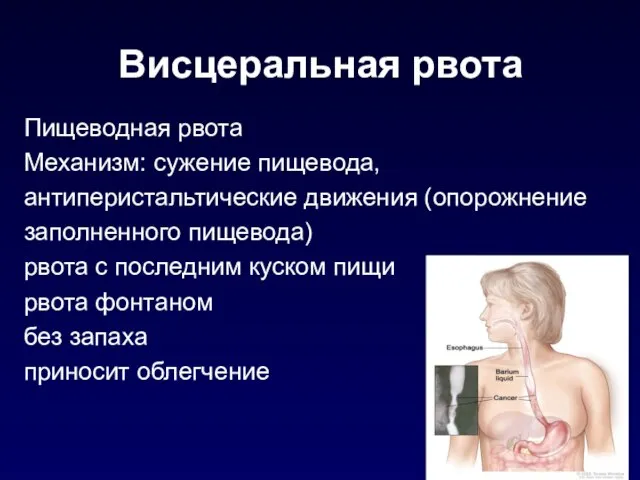 Висцеральная рвота Пищеводная рвота Механизм: сужение пищевода, антиперистальтические движения (опорожнение заполненного