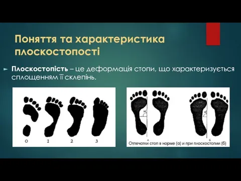 Поняття та характеристика плоскостопості Плоскостопість – це деформація стопи, що характеризується сплощенням її склепінь.