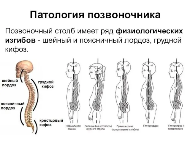 Патология позвоночника Позвоночный столб имеет ряд физиологических изгибов - шейный и поясничный лордоз, грудной кифоз.