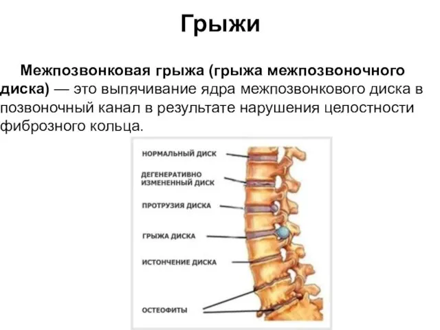 Грыжи Межпозвонковая грыжа (грыжа межпозвоночного диска) — это выпячивание ядра межпозвонкового