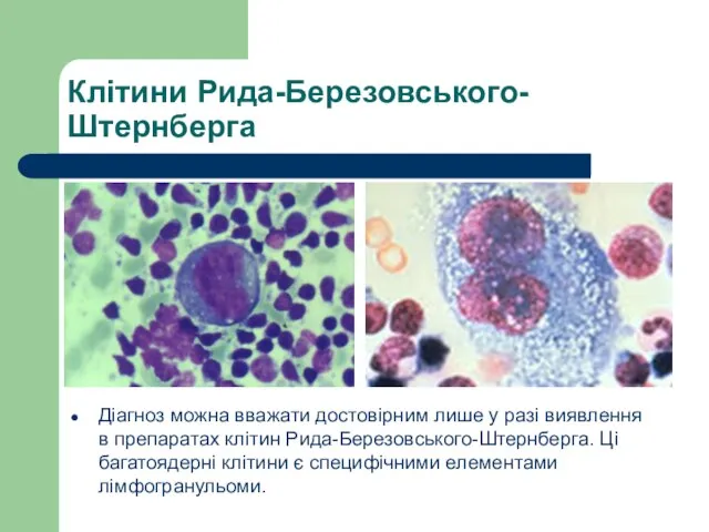 Клітини Рида-Березовського-Штернберга Діагноз можна вважати достовірним лише у разі виявлення в