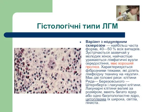 Гістологічні типи ЛГМ Варіант з нодулярним склерозом — найбільш часта форма,