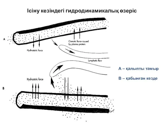 Ісіну кезіндегі гидродинамикалық өзеріс А – қалыпты тамыр В – қабынған кезде