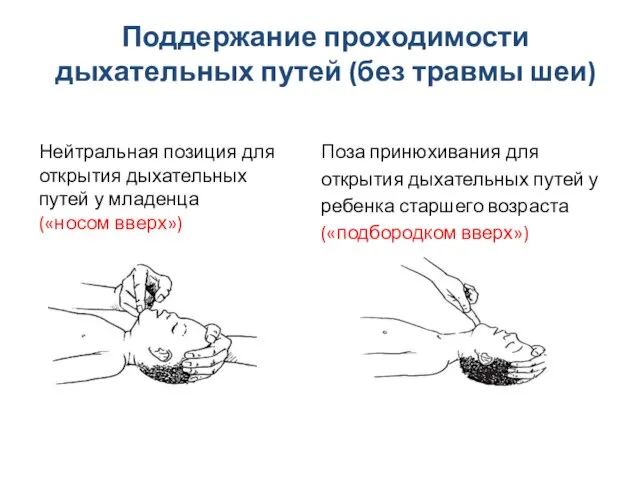 Поддержание проходимости дыхательных путей (без травмы шеи) Нейтральная позиция для открытия