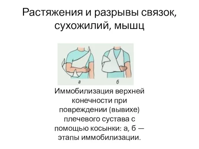 Растяжения и разрывы связок, сухожилий, мышц Иммобилизация верхней конечности при повреждении