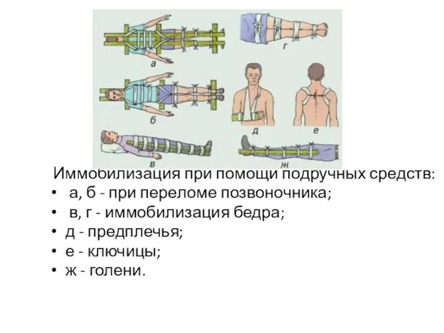 Иммобилизация при помощи подручных средств: а, б - при переломе позвоночника;