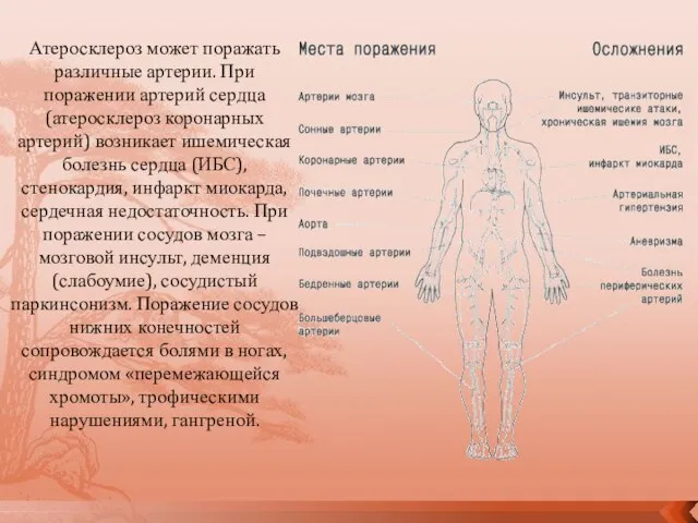 Атеросклероз может поражать различные артерии. При поражении артерий сердца (атеросклероз коронарных