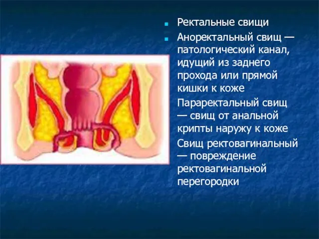 Ректальные свищи Аноректальный свищ — патологический канал, идущий из заднего прохода