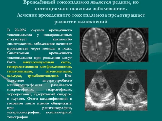 Врождённый токсоплазмоз является редким, но потенциально опасным заболеванием. Лечение врожденного токсоплазмоза