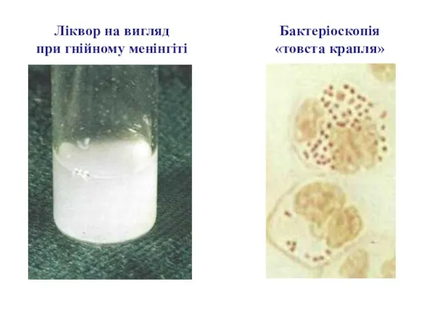 Ліквор на вигляд при гнійному менінгіті Бактеріоскопія «товста крапля»