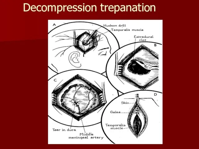 Decompression trepanation