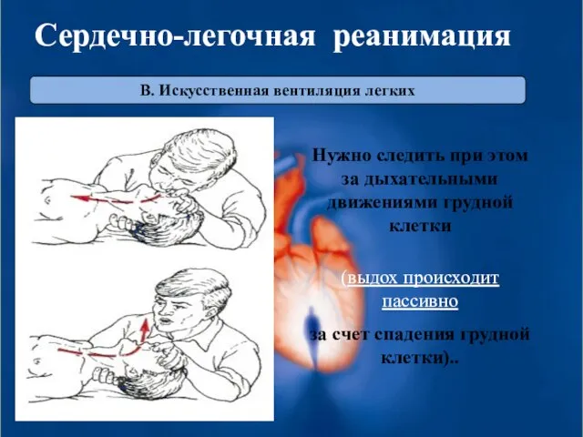 В. Искусственная вентиляция легких Сердечно-легочная реанимация Нужно следить при этом за