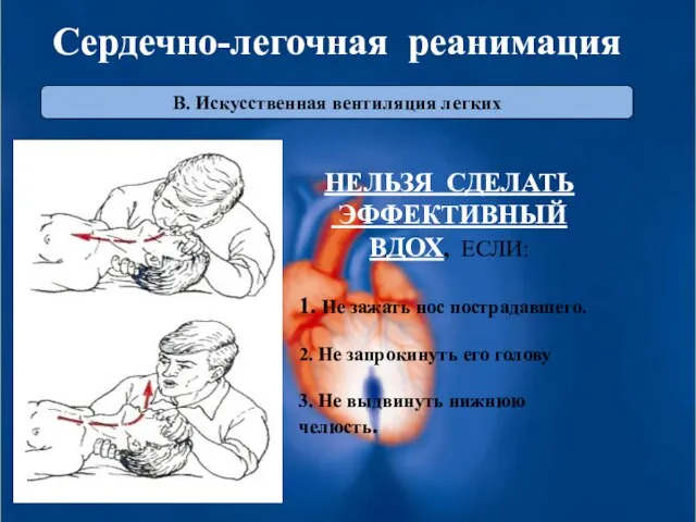 В. Искусственная вентиляция легких Сердечно-легочная реанимация НЕЛЬЗЯ СДЕЛАТЬ ЭФФЕКТИВНЫЙ ВДОХ, ЕСЛИ: