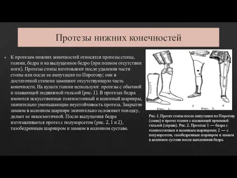 Протезы нижних конечностей К протезам нижних конечностей относятся протезы стопы, голени,