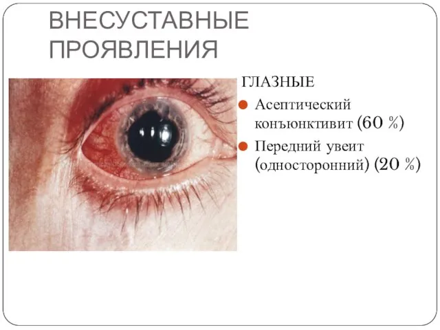 ВНЕСУСТАВНЫЕ ПРОЯВЛЕНИЯ ГЛАЗНЫЕ Асептический конъюнктивит (60 %) Передний увеит (односторонний) (20 %)