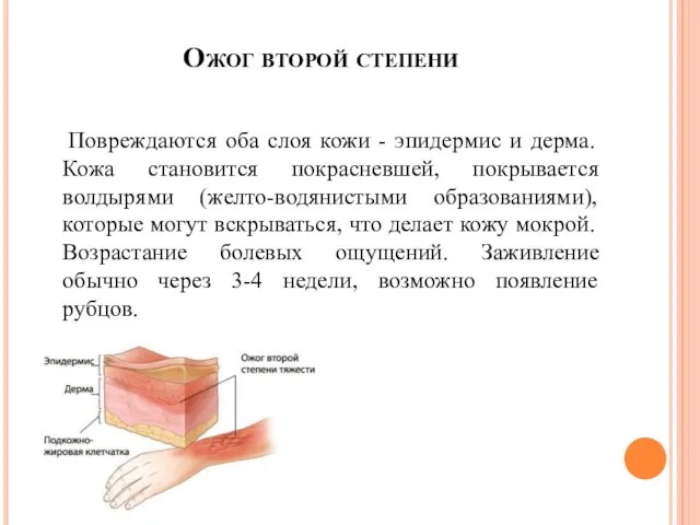 Ожог второй степени Повреждаются оба слоя кожи - эпидермис и дерма.