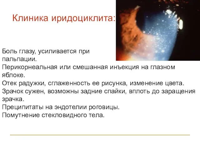 Клиника иридоциклита: Боль глазу, усиливается при пальпации. Перикорнеальная или смешанная инъекция