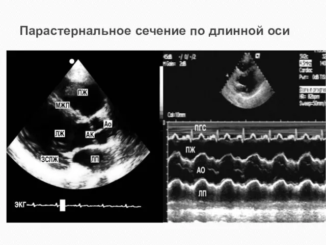 Парастернальное сечение по длинной оси