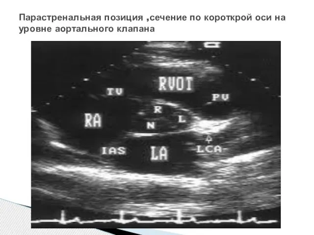 Парастренальная позиция ,сечение по короткрой оси на уровне аортального клапана
