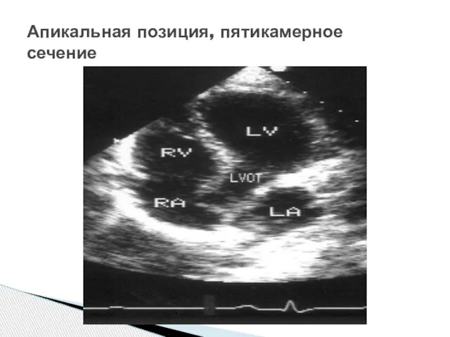 Апикальная позиция, пятикамерное сечение