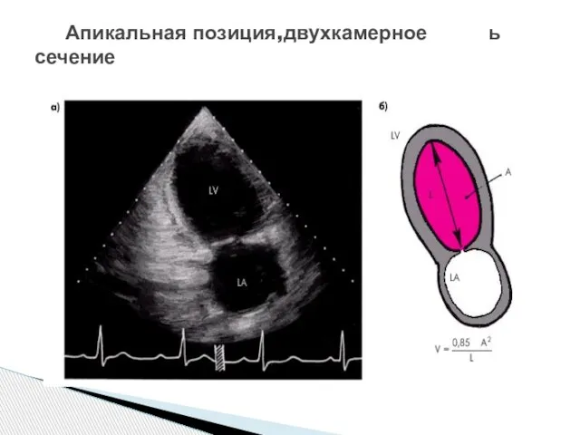 Апикальная позиция,двухкамерное ь сечение