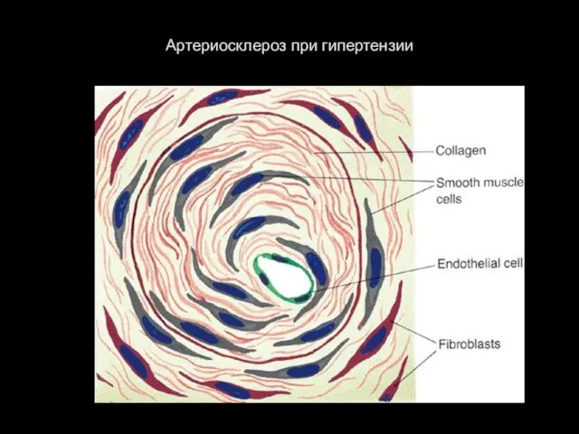 Артериосклероз при гипертензии