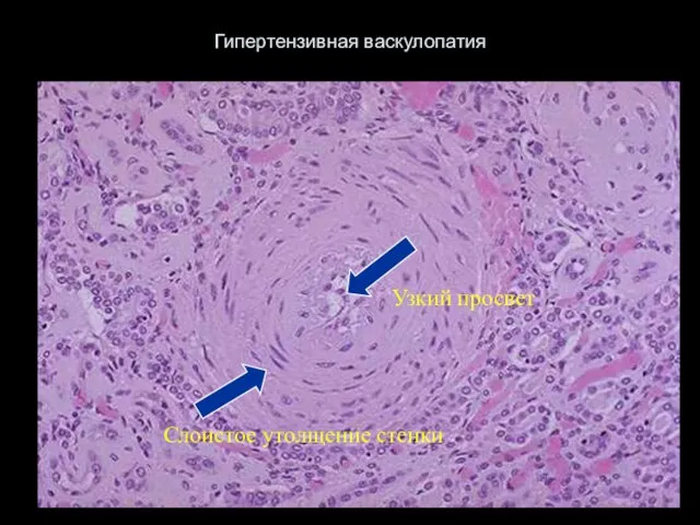 Гипертензивная васкулопатия Слоистое утолщение стенки Узкий просвет