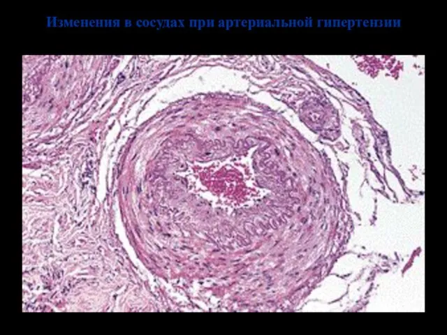 Изменения в сосудах при артериальной гипертензии