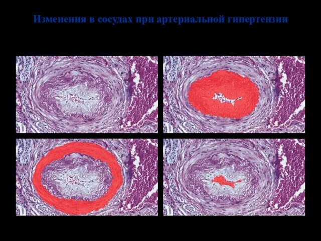 Изменения в сосудах при артериальной гипертензии