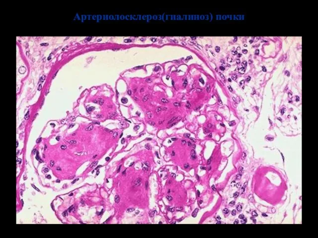 Артериолосклероз(гиалиноз) почки