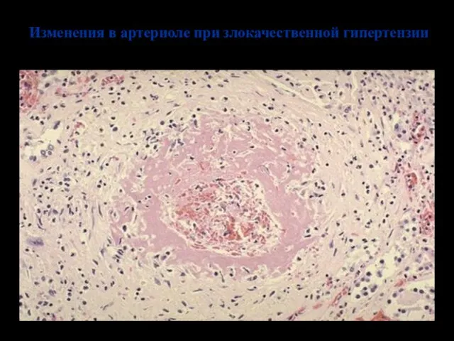 Изменения в артериоле при злокачественной гипертензии