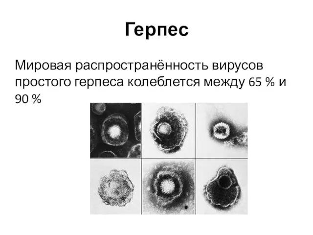 Герпес Мировая распространённость вирусов простого герпеса колеблется между 65 % и 90 %