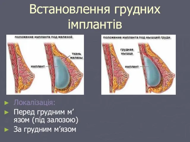 Встановлення грудних імплантів Локалізація: Перед грудним м’язом (під залозою) За грудним м’язом