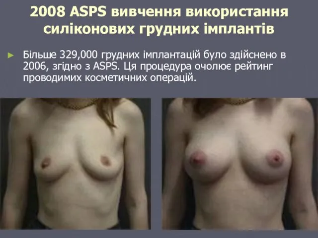 2008 ASPS вивчення використання силіконових грудних імплантів Більше 329,000 грудних імплантацій