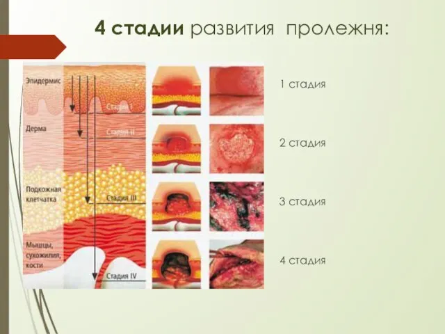 4 стадии развития пролежня: 1 стадия 2 стадия 3 стадия 4 стадия