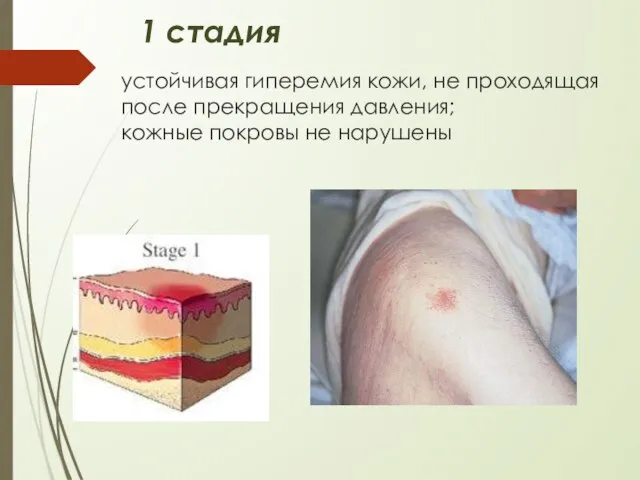 устойчивая гиперемия кожи, не проходящая после прекращения давления; кожные покровы не нарушены 1 стадия