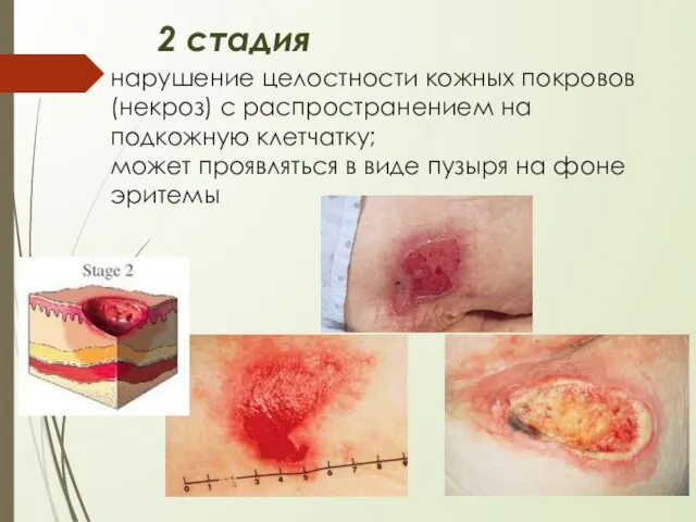 нарушение целостности кожных покровов (некроз) с распространением на подкожную клетчатку; может