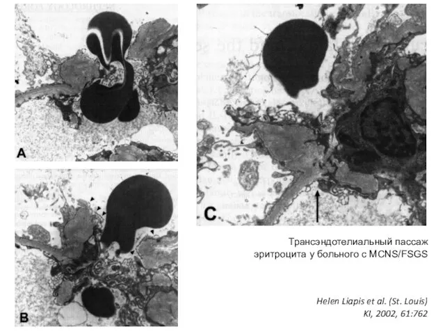 Трансэндотелиальный пассаж эритроцита у больного с МСNS/FSGS Helen Liapis et al. (St. Louis) KI, 2002, 61:762