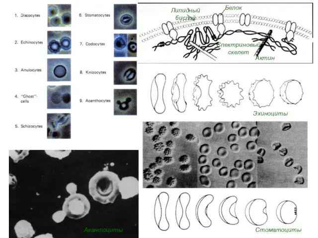 Акантоциты Стоматоциты Эхиноциты Белок Липидный бислой Спектриновый скелет Актин