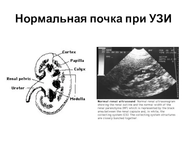 Нормальная почка при УЗИ