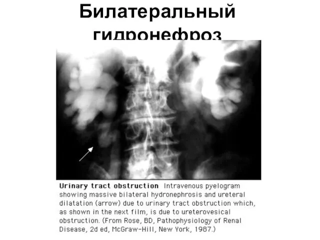 Билатеральный гидронефроз