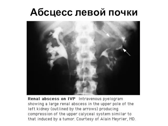 Абсцесс левой почки