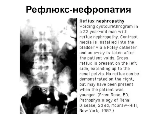 Рефлюкс-нефропатия