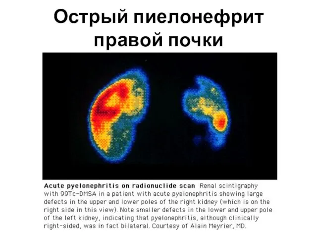 Острый пиелонефрит правой почки