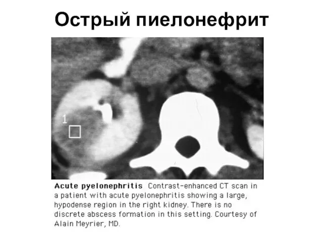 Острый пиелонефрит