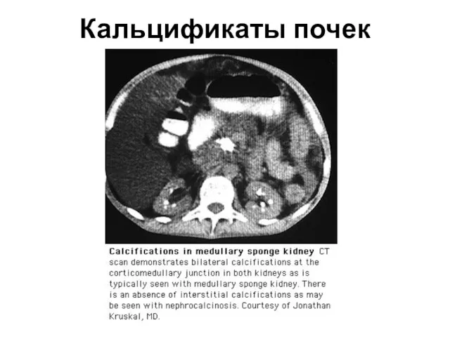 Кальцификаты почек