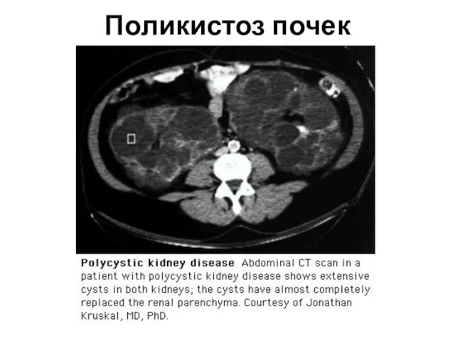 Поликистоз почек