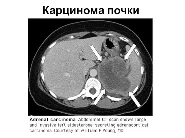 Карцинома почки